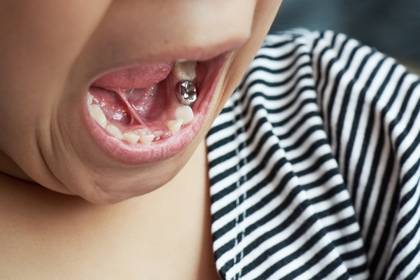 What To Know About Dental Crowns For Kids